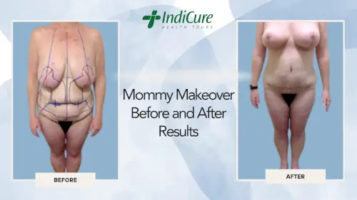 Mommy Makeover Before and After Results